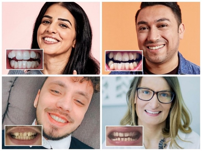 dr smile, aligneurs dentaires, aligneurs, orthodontie invisible