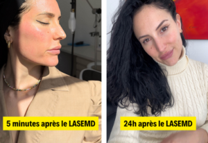 LASEMD, AVANT APRÈS, SOIN LASEMD, ÉCLAT DE LA PEAU