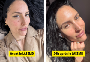 LASEMD, AVANT APRÈS, SOIN LASEMD, ÉCLAT DE LA PEAU